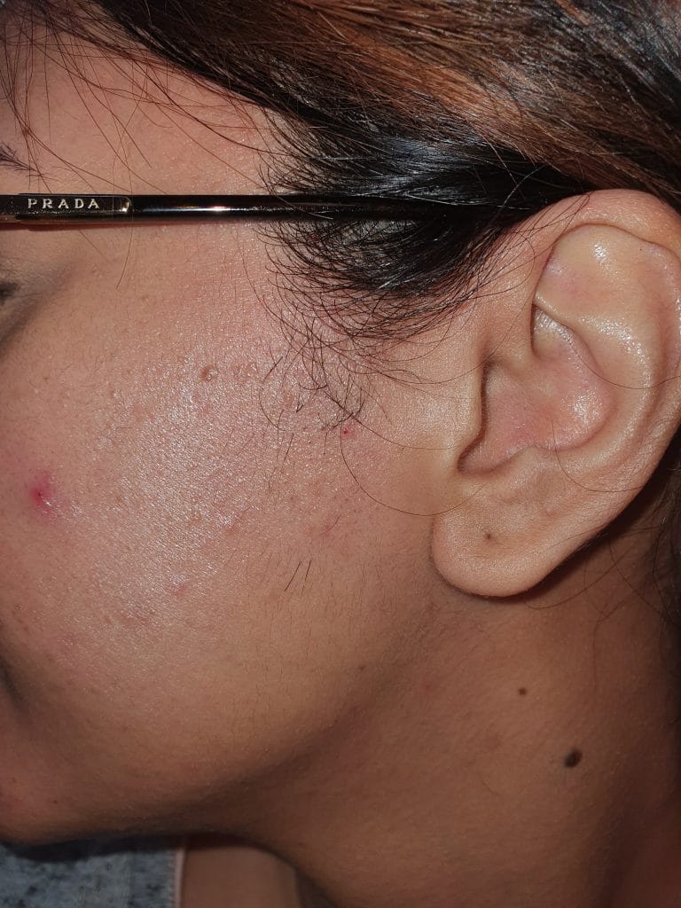 PCOS, polycystic ovaries, PCOS hair loss, PCOS hair loss treatment, PCOS hair removal, PCOS hair growth, treatment for pcos hair growth, pcos hair growth on face, pcos hair removal cream, pcos hair treatment, pcos hair on chin, pcos hair growth on face treatment, pcos hair on face, pcos hair growth patterns, does pcos hair growth get worse, laser hair removal, laser hair removal near me, laser hair removal machine, philips laser hair removal, best laser hair removal, is laser hair removal permanent, how long does laser hair removal last, laser hair removal at home, at home laser hair removal, hollywood laser hair removal, laser hair removal manchester, braun laser hair removal, how much is laser hair removal, brazilian laser hair removal, laser hair removal cost, does laser hair removal hurt, best at home laser hair removal, best home laser hair removal, facial laser hair removal, is laser hair removal safe, best laser hair removal machine, face laser hair removal, laser hair removal course, how many sessions of laser hair removal, laser hair removal for men, bikini laser hair removal, how does laser hair removal work, does laser hair removal work, how many sessions for laser hair removal, laser hair removal prices, diode laser hair removal, how many laser hair removal sessions, laser hair removal how many sessions, laser hair removal face, men's laser hair removal, aser hair removal before and after, how many laser hair removal treatments, full body laser hair removal, men laser hair removal, mens laser hair removal, laser hair removal side effects, laser hair removal clinic, laser hair removal device, laser hair removal burns, laser hair removal aftercare, is laser hair removal dangerous, laser hair removal price, laser hair removal courses, full body laser hair removal cost, laser hair removal prices uk, full brazilian laser hair removal before and after photos, laser hair removal bikini, professional laser hair removal machine, bikini line laser hair removal, laser hair removal chin, soprano laser hair removal, underarm laser hair removal, price for laser hair removal, how much does laser hair removal cost, post laser hair removal care, upper lip laser hair removal, laser hair removal machine professional, laser hair removal full body, laser hair removal men, chin laser hair removal, laser hair removal cost uk, does laser hair removal cause cancer, laser hair removal bikini area, laser hair removal salford, salford laser hair removal, mediacity, mediacityuk, cypress quay, Salford Quays,