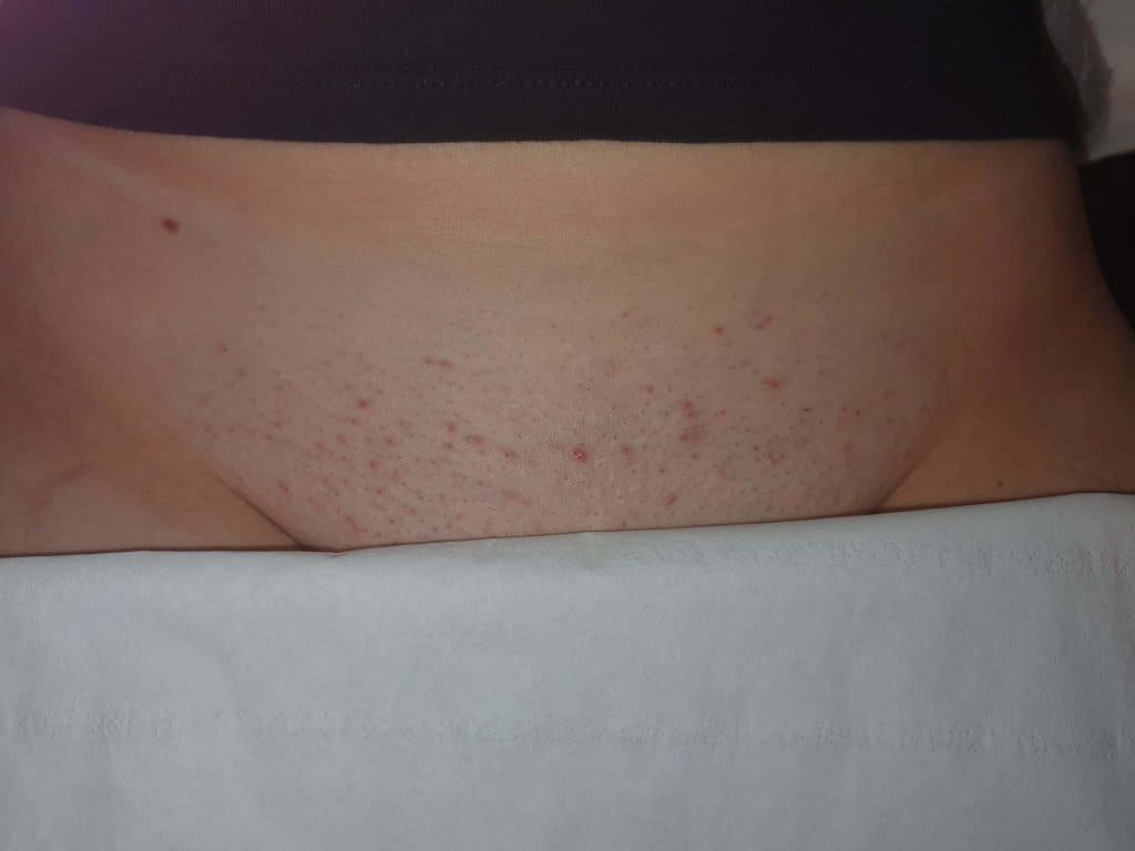 laser hair removal, laser hair removal near me, laser hair removal machine, philips laser hair removal, best laser hair removal, is laser hair removal permanent, how long does laser hair removal last, laser hair removal at home, at home laser hair removal, hollywood laser hair removal, laser hair removal manchester, braun laser hair removal, how much is laser hair removal, brazilian laser hair removal, laser hair removal cost, does laser hair removal hurt, best at home laser hair removal, best home laser hair removal, facial laser hair removal, is laser hair removal safe, best laser hair removal machine, face laser hair removal, laser hair removal course, how many sessions of laser hair removal, laser hair removal for men, bikini laser hair removal, how does laser hair removal work, does laser hair removal work, how many sessions for laser hair removal, laser hair removal prices, diode laser hair removal, how many laser hair removal sessions, laser hair removal how many sessions, laser hair removal face, men's laser hair removal, aser hair removal before and after, how many laser hair removal treatments, full body laser hair removal, men laser hair removal, mens laser hair removal, laser hair removal side effects, laser hair removal clinic, laser hair removal device, laser hair removal burns, laser hair removal aftercare, is laser hair removal dangerous, laser hair removal price, laser hair removal courses, full body laser hair removal cost, laser hair removal prices uk, full brazilian laser hair removal before and after photos, laser hair removal bikini, professional laser hair removal machine, bikini line laser hair removal, laser hair removal chin, soprano laser hair removal, underarm laser hair removal, price for laser hair removal, how much does laser hair removal cost, post laser hair removal care, upper lip laser hair removal, laser hair removal machine professional, laser hair removal full body, laser hair removal men, chin laser hair removal, laser hair removal cost uk, does laser hair removal cause cancer, laser hair removal bikini area, laser hair removal salford, salford laser hair removal, mediacity, mediacityuk, cypress quay, Salford Quays, ingrown hairs, how to get rid of ingrown hairs, how to stop ingrown hairs, how to prevent ingrown hairs, what causes ingrown hairs, prevent ingrown hairs, do ingrown hairs go away, how long do ingrown hairs last, what are ingrown hairs, ingrown hairs bikini line, ingrown hairs after waxing, how to avoid ingrown hairs, ingrown hairs after shaving, how to prevent ingrown hairs after shaving, how to stop ingrown hairs after shaving, how to avoid ingrown hairs after shaving, can ingrown hairs hurt, how to prevent ingrown hairs after waxing, how to stop ingrown hairs after waxing, how to avoid ingrown hairs after waxing, how to stop ingrown hairs on legs, ingrown hairs on face woman, waxing and ingrown hairs, getting rid of ingrown hairs