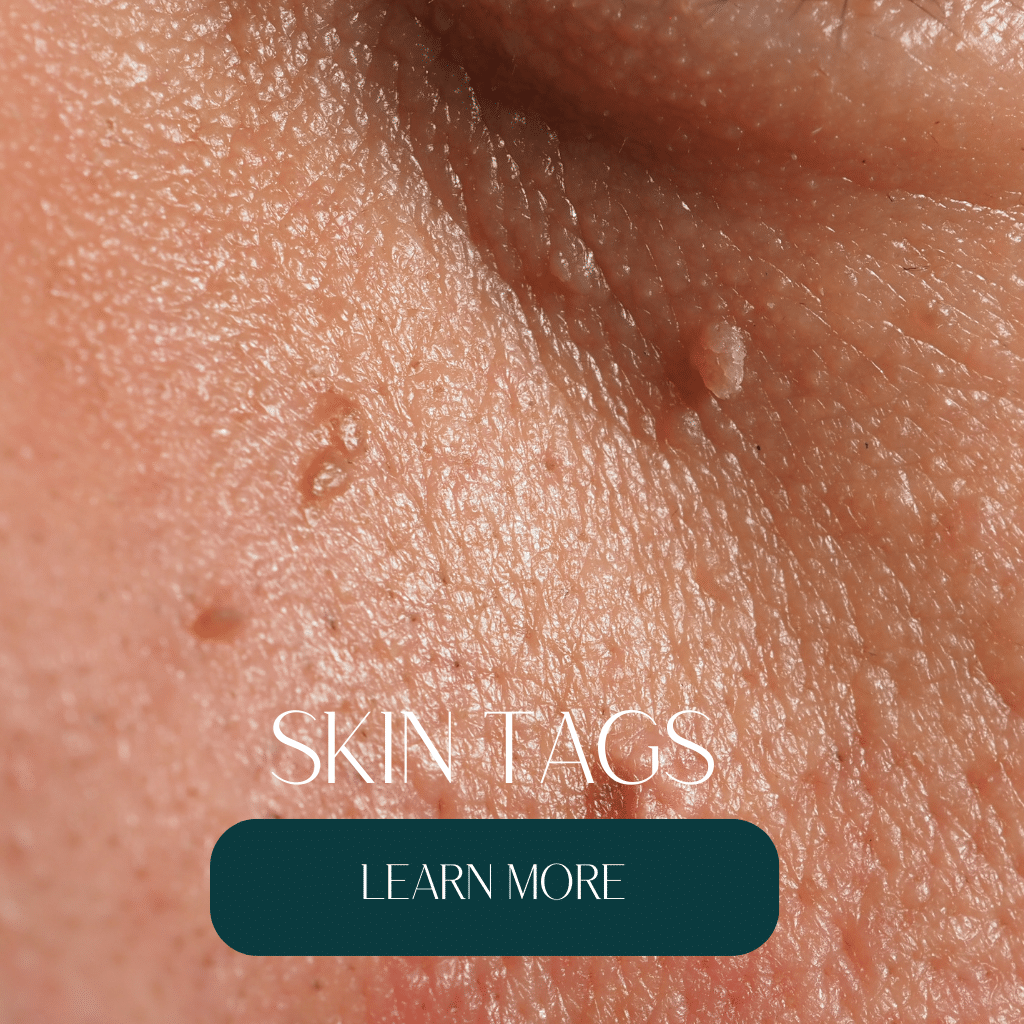 Skin tag removal, skin tag removal near me, skin tag removal cream, skin tag removal boots, boots skin tag removal, skin tag removal uk boots, skin tag removal patches, skin tag removal uk, skin tag removal manchester, manchester, salford, Salford Quays, mediacity, mediacityuk, skin tag removal cost, skin tag removal nhs, best skin tag removal uk, wart and skin tag removal, skin tag removal holland and Barrett, large skin tag removal, private skin tag removal, skin tag removal cost uk, skin tag removal private, skin tag removal Liverpool, skin tag removal laser, skin tag removal clinics near me, best skin tag removal, laser skin tag removal, how much is skin tag removal, skin tag removal around eyes, best skin tag removal products, cost of skin tag removal uk, skin tag removal clinic near me, skin tag removall freeze, skin tag removal under eye, skin tag removal clinic, how much does skin tag removal cost, dermatologist skin tag removal, private skin tag removal cost, small skin tag removal, skin tag removal private cost, eye skin tag removal, how much for skin tag removal, vaginal skin tag removal, skin tag removal dermatologist, mole and skin tag removal, skin tag removal near eye, private skin tag removal near me, nhs skin tag removal, nhs skin tags