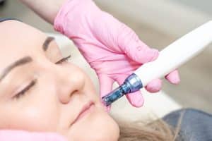microneedling, microneedling before and after, microneedling near me, manchester, mediacity, mediacityuk, salford quays, salford, microneedling facial, what is microneedling, microneedling benefits, microneedling manchester, manchester skin, manchester salon, manchester skin clinic, manchester beauty, manchester beauty clinic, microneedling pen, is microneedling worth it, microneedling acne scars, acne scars, acne scarring, derma pen microneedling, microneedling for pigmentation, skin pen microneedling, microneedling cost uk, microneedling aftercare, benefits of microneedling, microneedling and rosacea, microneedling prices, how long after microneedling can i wear makeup, how long does microneedling last, how often microneedling, microneedling vs microdermabrasion, microneedling reviews, microneedling rosacea, microneedling for wrinkles, microneedling uk, is microneedling painful, microneedling hyperpigmentation, cost of microneedling, what is microneedling good for, skin microneedling, microneedling downtime, microneedling stretch marks before and after, microneedling side effects, microneedling courses, microneedling serums, How Long Will Microneedling Last,